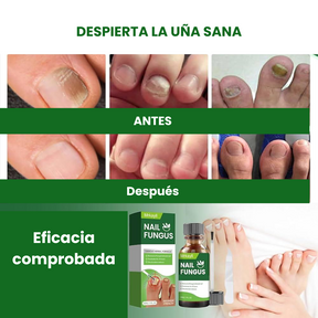 Dermauña - Tratamiento antimicótico para uñas